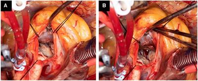 PlasmaBlade-assisted surgical septal myectomy: technique and our experience